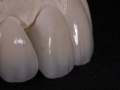 1.Feldspathic Veneers