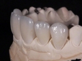 2.Feldspathic Veneers