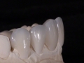 6.Feldspathic Veneers