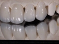 7.Feldspathic Veneers