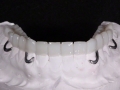 2.Metal Framed Lab Processed Orthotic