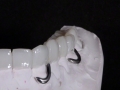3.Metal Framed Lab Processed Orthotic