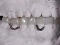5.Metal Framed Lab Processed Orthotic