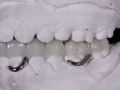 6.Metal Framed Lab Processed Orthotic