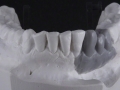 2.Waxed;Screw Retained Zirconia Implant Bridge