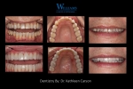 Full Mouth Rehabilitation