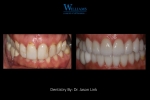 Full Mouth Rehabilitation By Dr. Jason Link