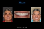 Full Mouth Rehabilitation by Dr.Raul Garcia