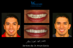 Smile Makeover with Veneers by Dr. Arturo Garcia