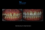 Smile Makeover by Dr. Brad Durham