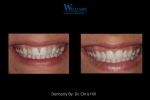 Smile Makeover by Dr. Chris Hill