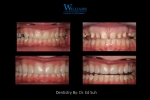 Smile Makeover by Dr. Edmond Suh