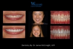 Smile Makeover by Dr. James McCreight
