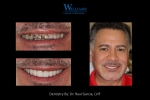 Smile Makeover by Dr.Raul Garcia