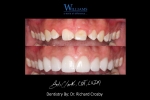 Smile Makeover with Veneers by Dr. Richard Crosby