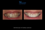 Veneers by Dr. Stanley Levenson