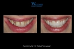 Veneers by Dr.Balaji Srinivasan