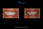 Veneers by Dr. Chris Hill