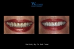 Veneers by Dr. Rick Coker