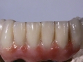 3. Zirconia Implant Bridge
